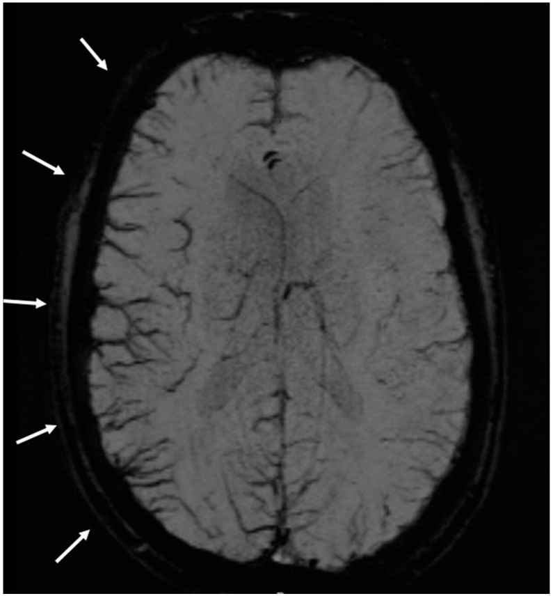 Susceptibility Weighted Imaging in Migraines with and Without Aura: A Case-Control Study.