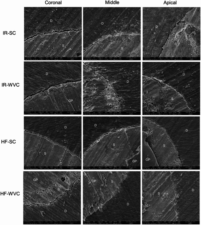 Marginal adaptation of heat and non-heat compatible bioceramic sealers in warm obturation: an in vitro SEM study.