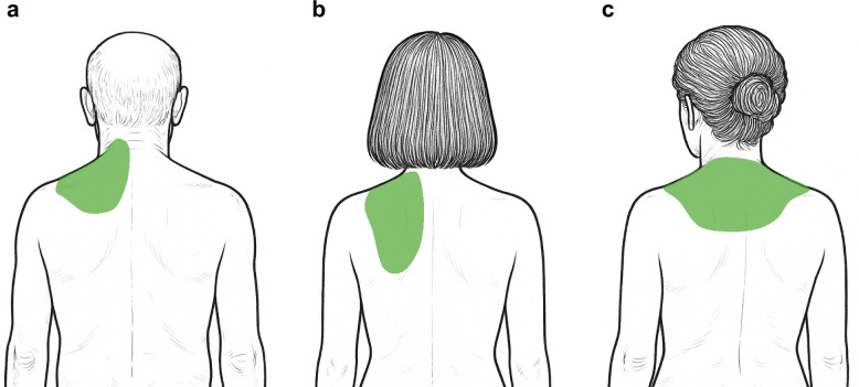 Ultrasound-guided serratus posterior superior muscle block for myofascial pain syndrome in the cervicoscapular region: a report of three cases.