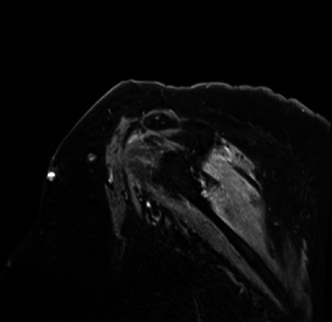 Bilateral Parsonage-Turner Syndrome in a Patient With Hemophagocytic Lymphohistiocytosis.