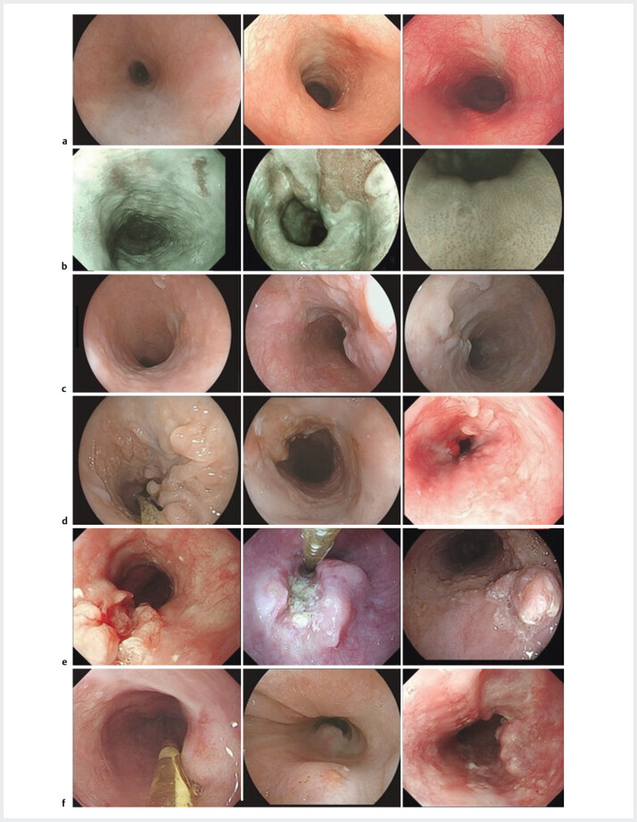 Pathologic complete response after neoadjuvant therapy for resectable esophageal squamous cell carcinoma: Endoscopic characteristics and implications.