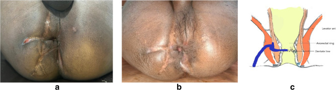 IFTAK (Interception of Fistulous Tract with Application of Ksharasutra) technique: a minimally invasive solution for recurrent fistula-in-ano-a case series analysis.