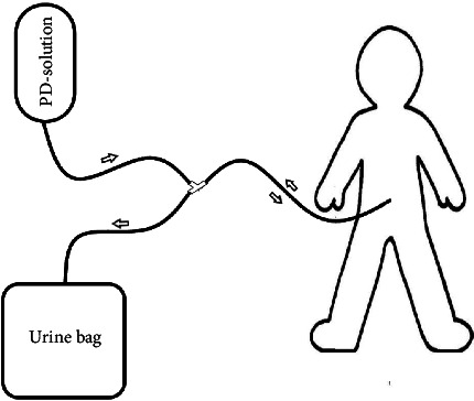 A Detailed Description of Locally Available Peritoneal Dialysis in a Low-Resource Setting: A Case Report.