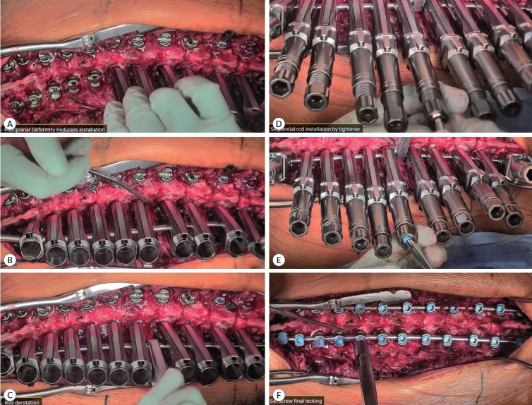 Efficacy Comparison of Multiplanar Deformity Reducer System and Direct Vertebral Rotation in Adolescent Idiopathic Scoliosis Corrective Surgery.