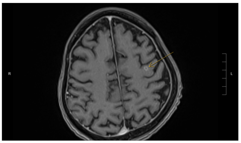 The Diagnostic Challenges of Disseminated Nocardiosis in a Post-Renal Transplant Patient: A Case Report.