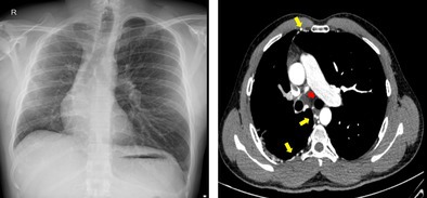 Breathing With Half a Pulmonary Circuit: Three Cases of Unilateral Pulmonary Artery Agenesis.