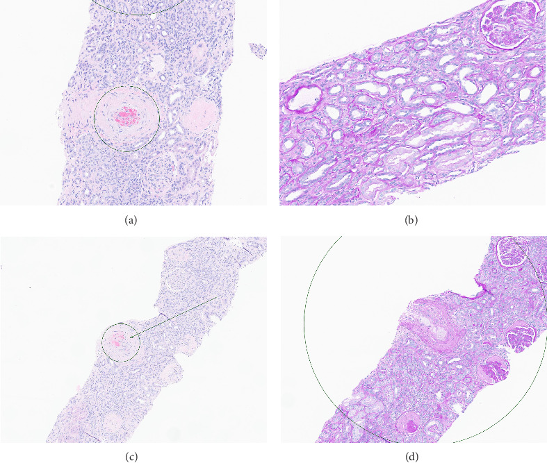 Renal Thrombotic Microangiopathy due to Hypertensive Emergency.