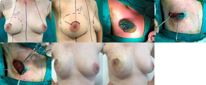 Simultaneous Implant and Dermal Flap Technique for Breast Reconstruction After Skin-Sparing Total Mastectomy for Breast Carcinoma.