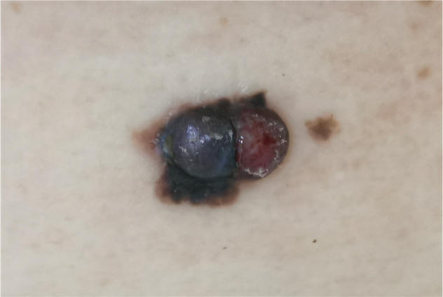 Melanoma during Ruxolitinib Treatment for Myelofibrosis.