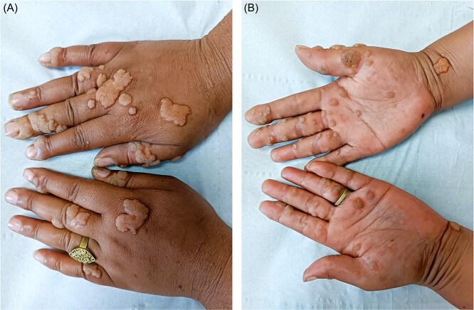 A case of classic epidermodysplasia verruciformis associated with elephantiasis: an atypical presentation.