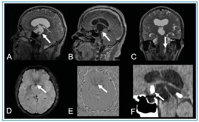 Racemose neurocysticercosis mimicking craniopharyngioma.
