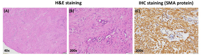 Painful Angiomyoma of the Heel Region: A Rare Case Report.