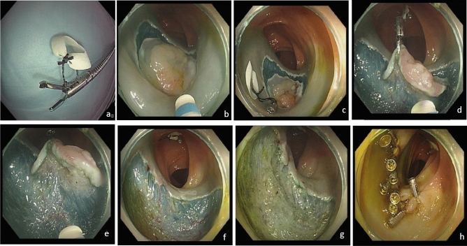 Hemoclip-suture-rubber band traction improves efficiency of colonic ESD: a randomized controlled trial.