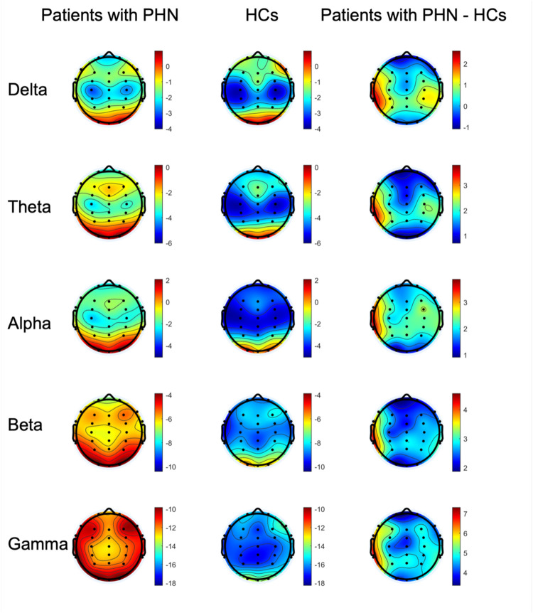 Altered neural oscillation patterns and functional connectivity in postherpetic neuralgia: evidence from resting-state EEG.