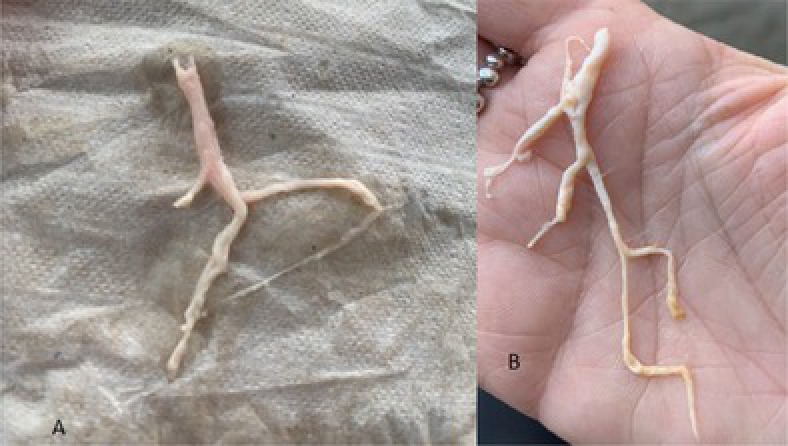 Rare Adult Case of Plastic Bronchitis in an Otherwise Healthy Adult.