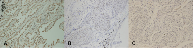 Predictive Value of Tumor ERCC1 Expression for Treatment Outcomes After Adjuvant Chemotherapy in Patients with Completely Resected Non-Small Cell Lung Cancer.