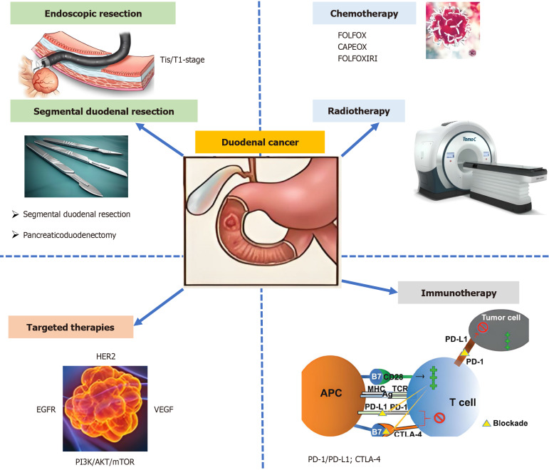 Progress in the treatment of duodenal cancer: A comprehensive review.