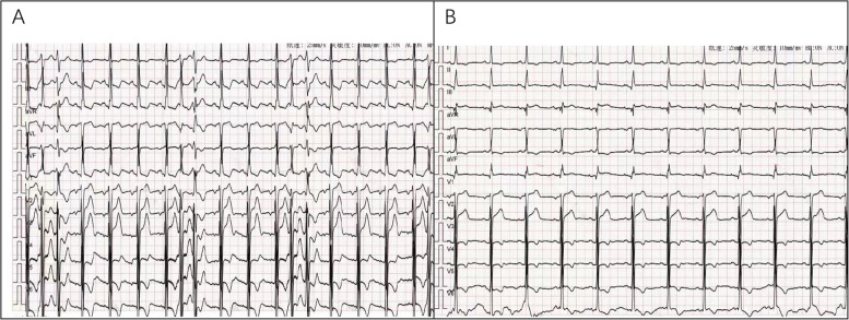 Successful management of cardiac electrical storm after aortic valve replacement using stellate ganglion block: a case report.