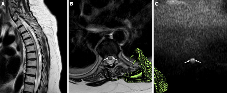 Spinal cord ischemia: The "snake bite sign".