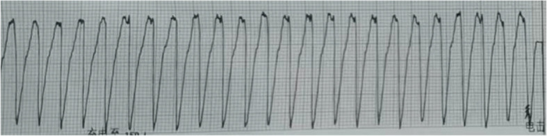 Successful management of cardiac electrical storm after aortic valve replacement using stellate ganglion block: a case report.
