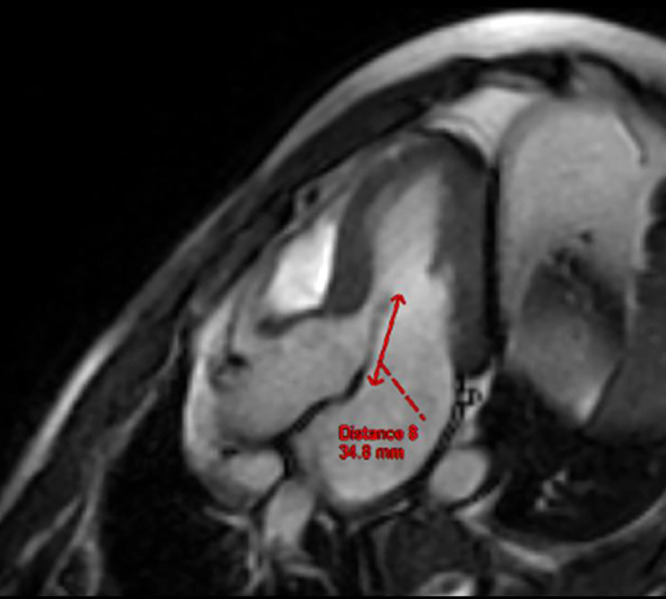 An Unusual Etiology of Presyncopal Episodes: Dynamic Left Ventricular Outflow Tract Obstruction Secondary to an Elongated Anterior Mitral Valve Leaflet.