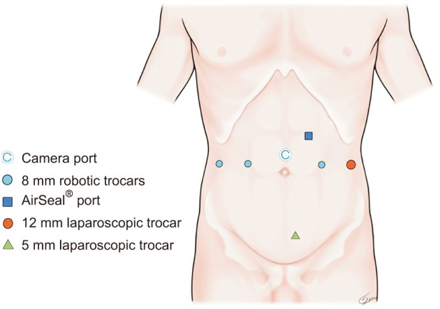 Totally intracorporeal ileal neobladder following robot-assisted radical cystectomy in male patients using the Juntendo technique: Initial experience.