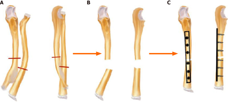 Ulnar lengthening in the treatment of forearm deformity caused by hereditary multiple exostoses in children.