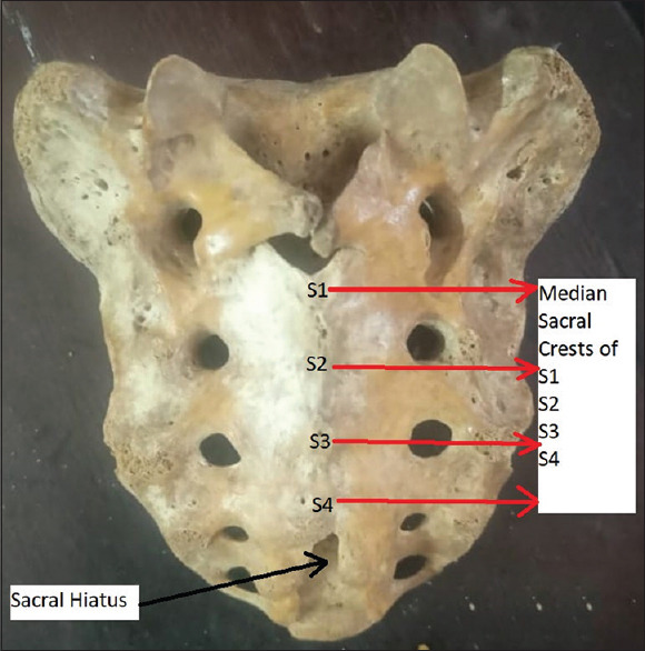 Sacral erector spinae block: A new era for postoperative analgesia-a narrative review.