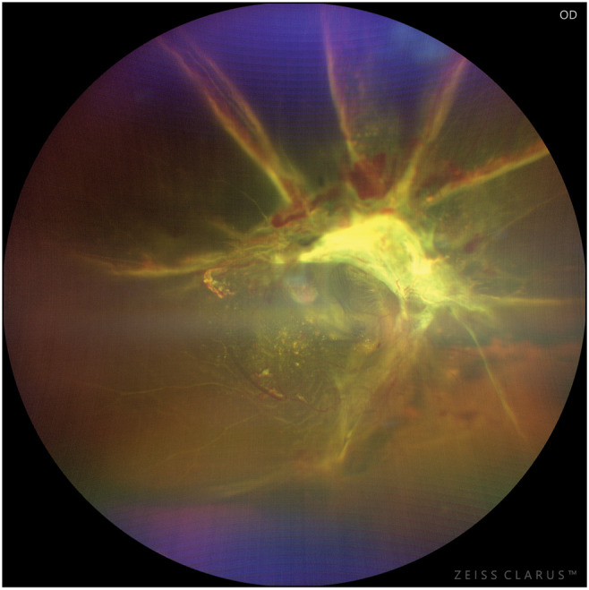 Proliferative Diabetic Retinopathy in Nigerians: Treatment Methods, Visual Outcomes, and Predictors of Poor Outcomes.