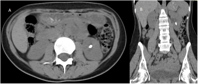 Spontaneous retrograde migration of a ureteric calculus: a rare phenomenon.