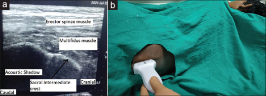 Sacral erector spinae block: A new era for postoperative analgesia-a narrative review.