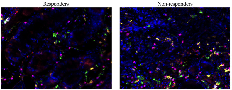 PD-1-Positive CD8+ T Cells and PD-1-Positive FoxP3+ Cells in Tumor Microenvironment Predict Response to Neoadjuvant Chemoimmunotherapy in Gastric Cancer Patients.