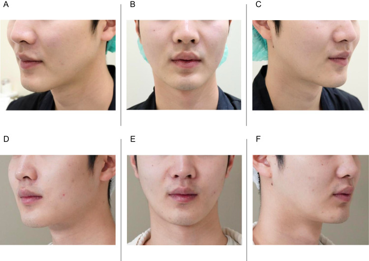 Micro-Focused Ultrasound on an Individual with Titanium Facial Implants: A Case Report.