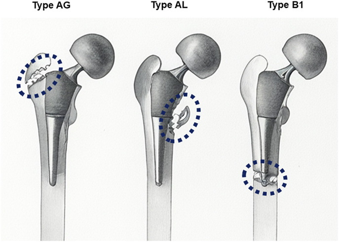 Older Patients Undergoing Bipolar Hemiarthroplasty Face a Higher Risk of Intraoperative Fractures and Longer Hospital Stays on Delayed Surgery After Injury: A Multicenter Study.