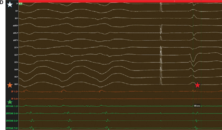 Electrogram Dynamics at the Site of Ventricular Tachycardia Termination During Radiofrequency Ablation.