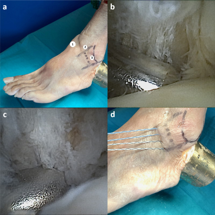 Biomechanical testing of lateral and medial ligament reconstruction using bone anchors with autologous resident tissue: influence of different reconstruction techniques on stability and mobility.