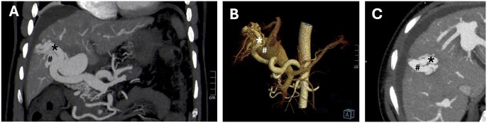 Hepatic barrage to high-flow, intra-hepatic arteroportal fistulas requiring combined interventional approach.