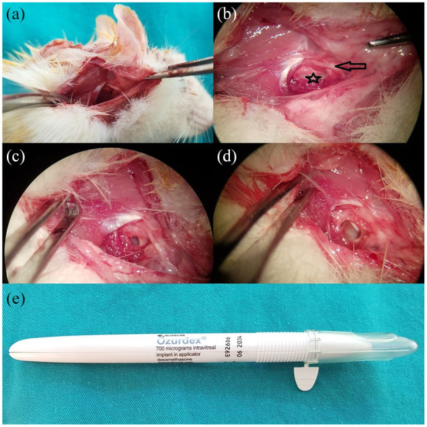 Preventive Effect of Controlled-Release Dexamethasone on Cochlear Ossification in Meningitis Model.