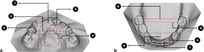 The Characteristic of Transverse Dental Arch Relationship Study in Unilateral Cleft and Palate versus Noncleft in Thai Northeastern Population.
