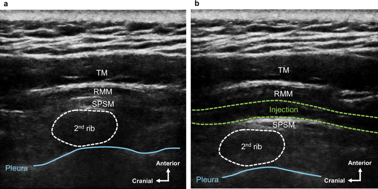 Ultrasound-guided serratus posterior superior muscle block for myofascial pain syndrome in the cervicoscapular region: a report of three cases.