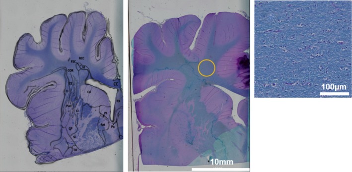 Volumetric and Diffusion Tensor Imaging Abnormalities Are Associated With Behavioral Changes Post-Concussion in a Youth Pig Model of Mild Traumatic Brain Injury.