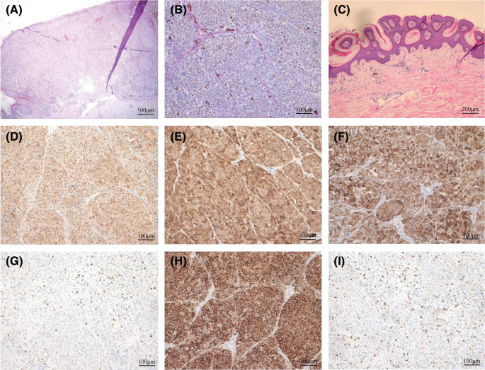Melanoma during Ruxolitinib Treatment for Myelofibrosis.