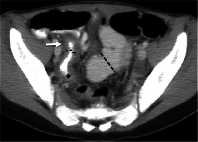 Baseline terminal ileal CT and MRI measurements are associated with imaging outcomes in pediatric Crohn's disease: a cohort study.