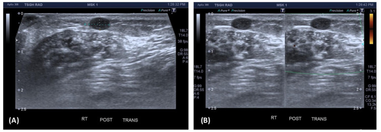 Painful Angiomyoma of the Heel Region: A Rare Case Report.