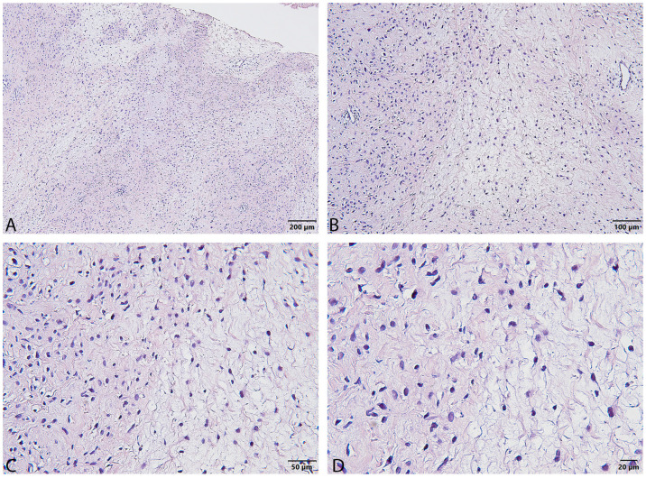 Giant Atypical Neurofibroma of the Calf in Neurofibromatosis Type 1: Case Report and Literature Review.