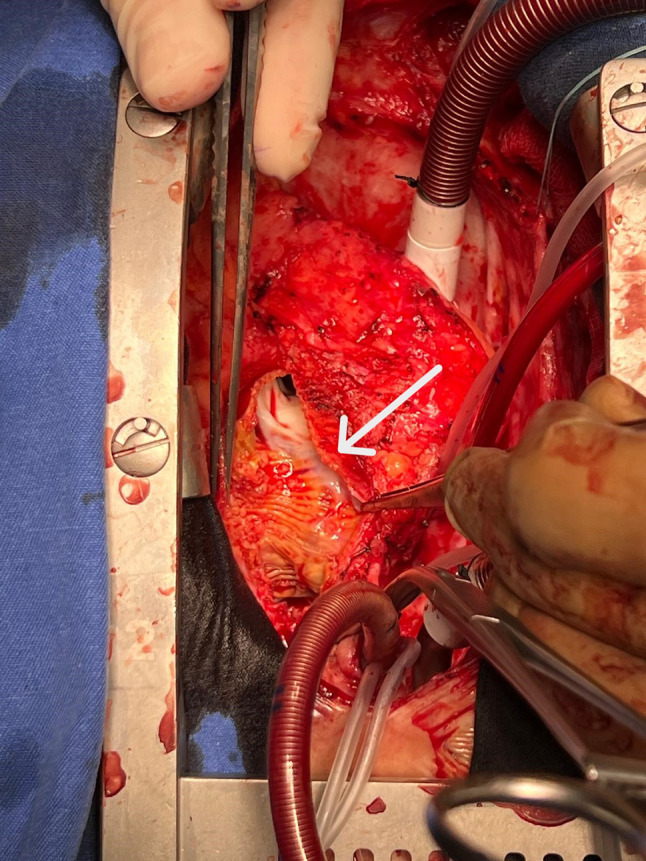 A rare case of coronary artery bypass grafting in pediatric cardiac surgery: emphasizing the importance of internal thoracic artery usage.