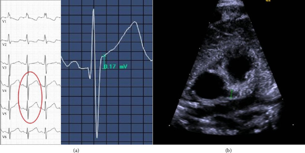 Clinical Presentation and Outcome of Five Neonates With Enterovirus Central Nervous System Infection: Contrasting One Kawasaki-Like Case With Cardiac Involvement and Seizures With Four Benign Cases.