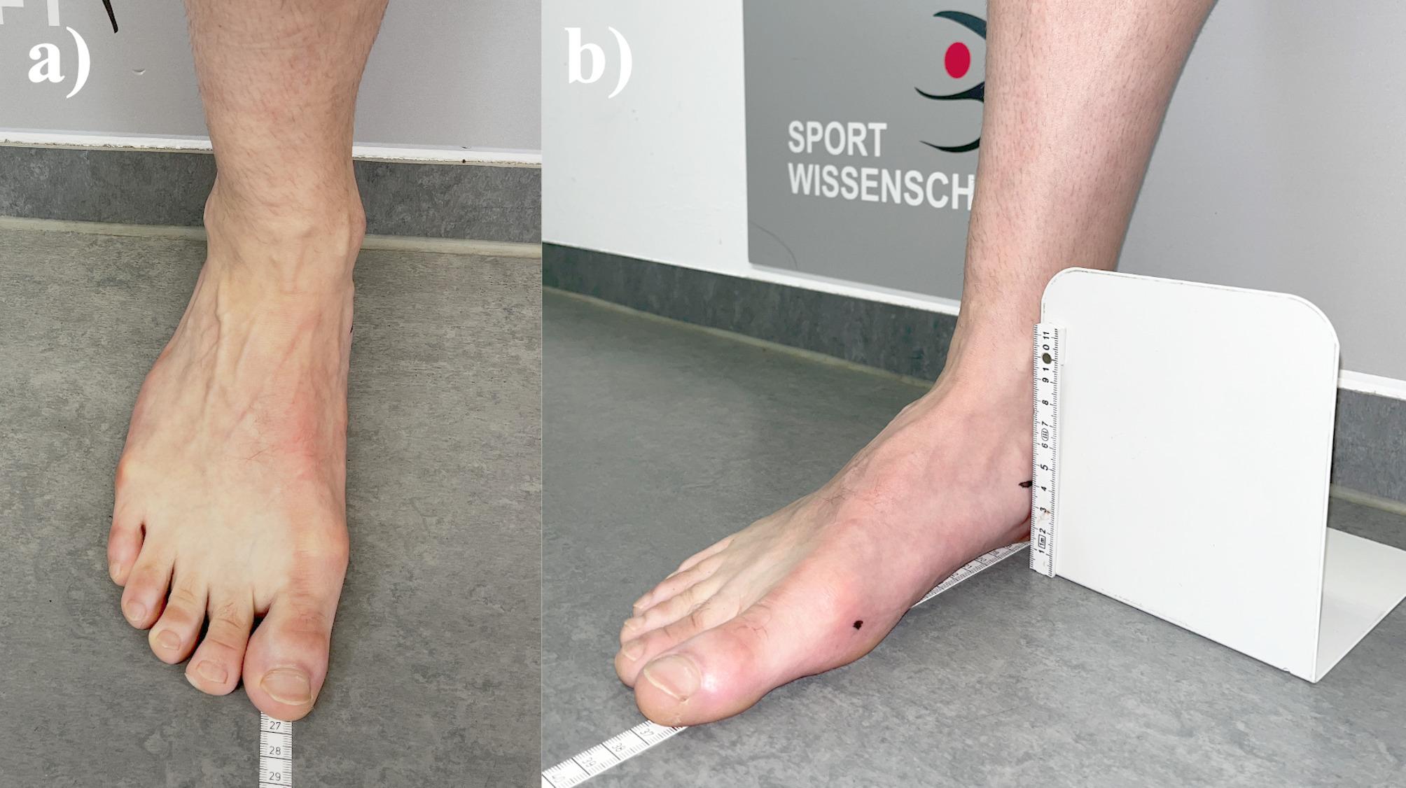 A potential relationship between soccer shoes and pes cavus: a pilot study.