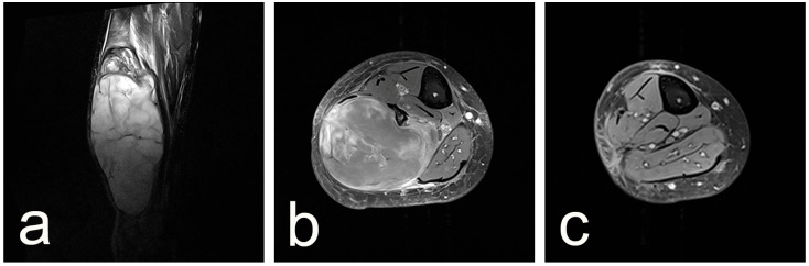 Giant Atypical Neurofibroma of the Calf in Neurofibromatosis Type 1: Case Report and Literature Review.