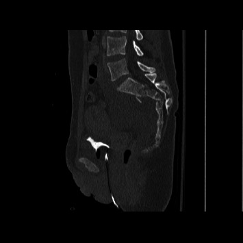 Outcomes of Percutaneous Versus Open Lumbopelvic Fixation of Spinopelvic Dissociation.